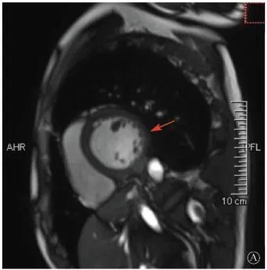 【惊人】基因检测解决心血管疾病诊断和治疗疑难