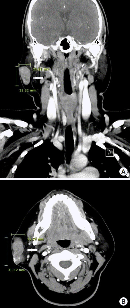 【佳学基因检测】巨大毛母质瘤的基因检测案例