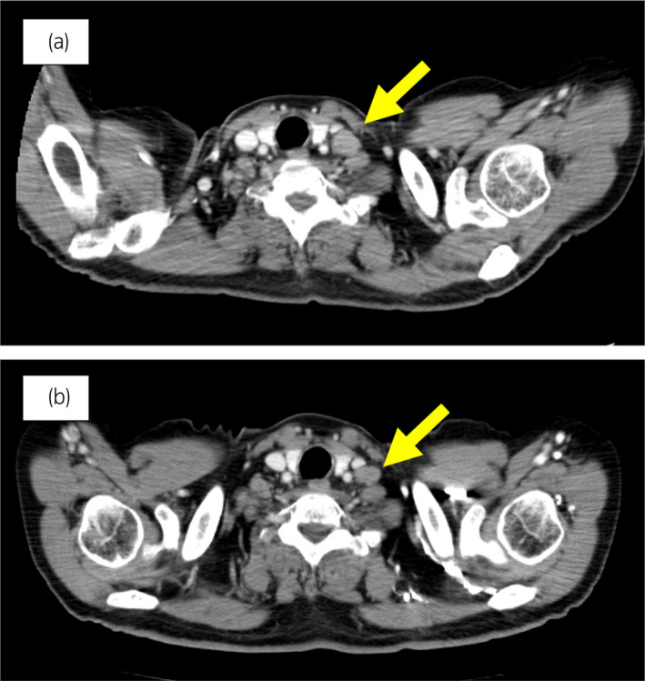 【佳学基因检测】靶向药物奥拉帕尼治疗具有BRCA突变的前列腺癌患者