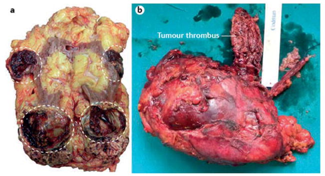 【佳学基因检测】肾脏癌靶向药物基因检测（Kidney Cancer)