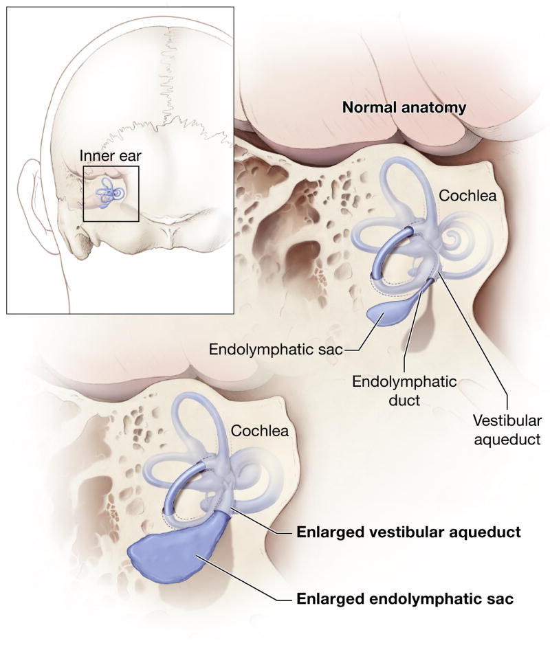 【佳学基因检测】前庭窗异常基因检测 Abnormality of the vestibular window