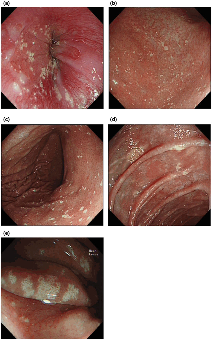 【佳学基因检测】CHILD综合征基因解码、基因检测有什么用？