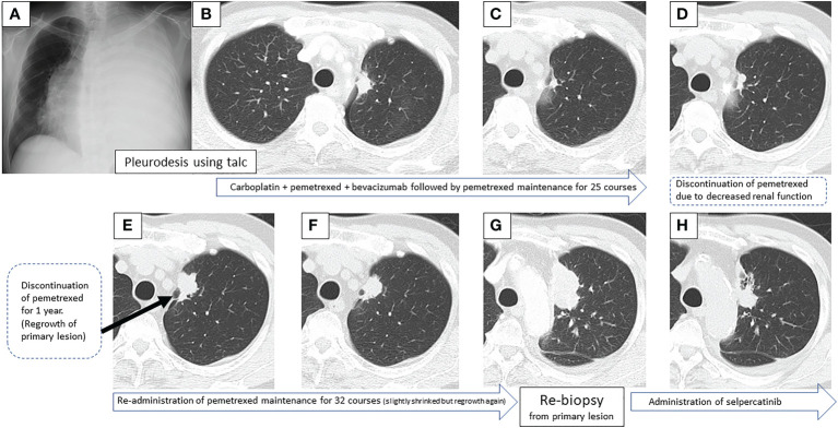 【佳学基因检测】肺癌靶向药物基因检测为什么要包含RET重排 【佳学基因检测】肺癌靶向药物基因检测为什么要包含RET重排