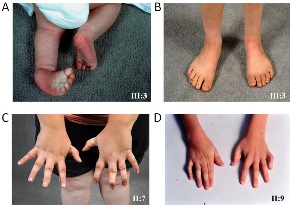 【佳学基因检测】采用外显子测序基因检测明确关节弯曲是一种AMCD1遗传病