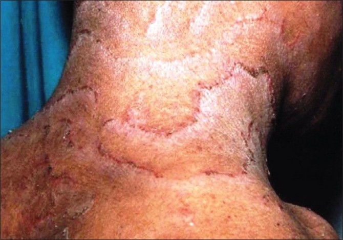 【佳学基因检测】竹节状头发综合征基因检测Bamboo hair syndrome