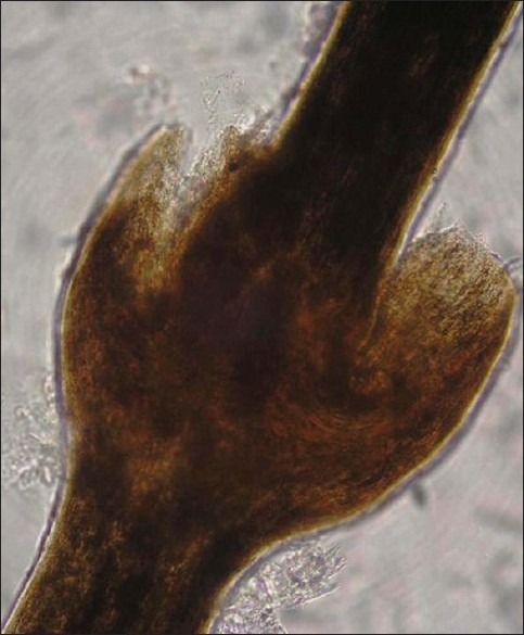 【佳学基因检测】竹节状头发综合征基因检测Bamboo hair syndrome