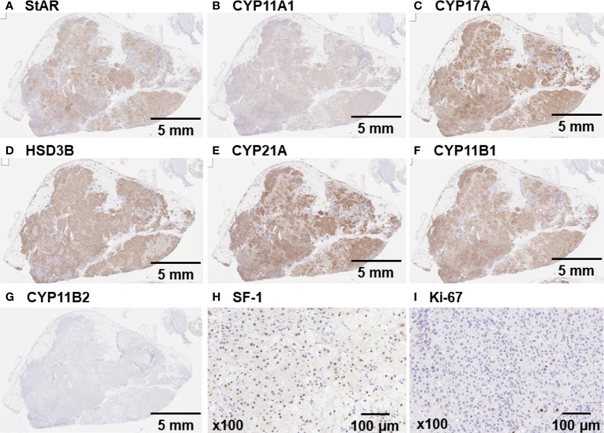 【佳学基因检测】非依赖性库欣综合征及McCune-Albright 综合征伴有中枢性闭经和甲状腺功能减退症的基因检测