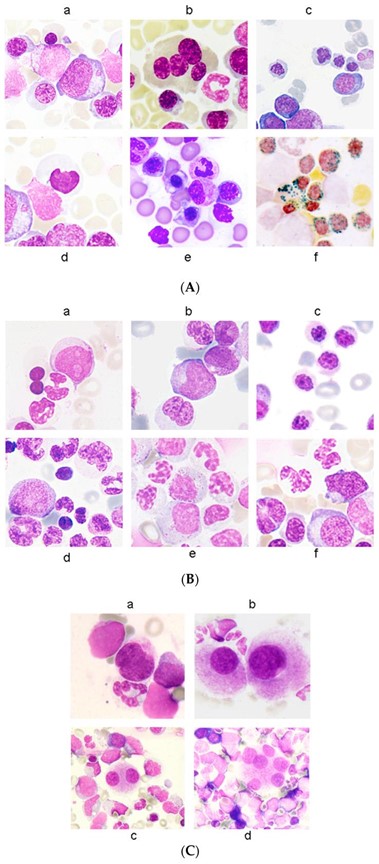 【佳学基因检测】骨髓增生异常综合征的基因解码与基因检测：诊断和筛查基础