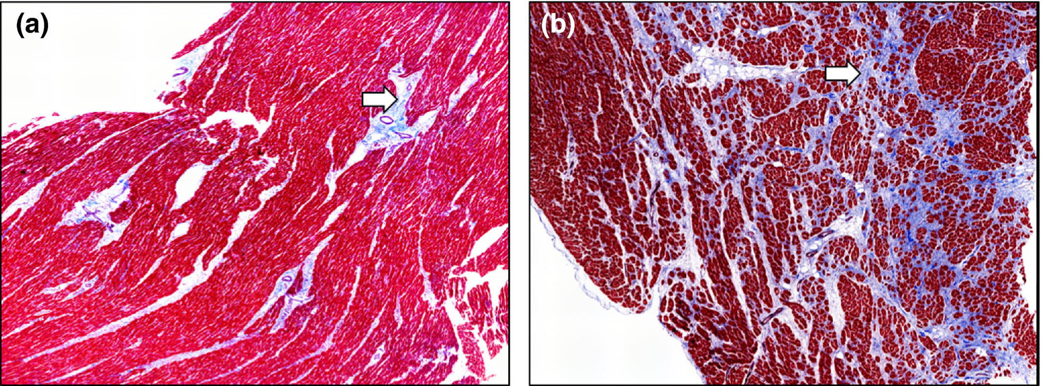 【佳学基因检测】理解发病机理，选择准确的扩张性心肌病基因检测