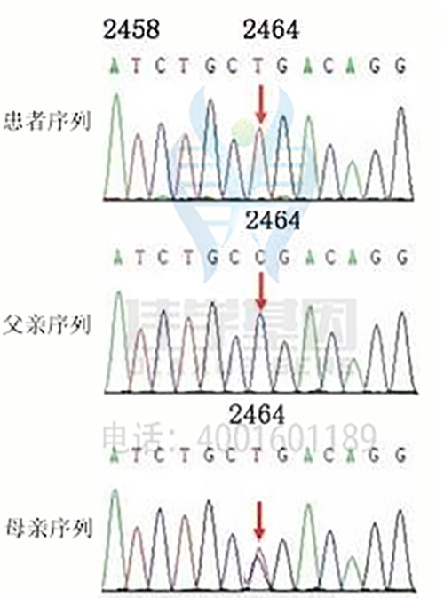 【基因检测基因解码案例】洛伊综合征(LOWE SYNDROME)——佳学基因